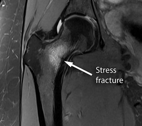 Hip stress fracture | Upper East Orthopaedics Blog