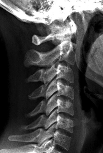 Cervical spine xray