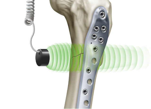 Exogen Bone Stimulator, The Knee Clinic