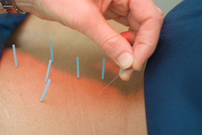 Acupuncture - Rachel E. Bergang MD